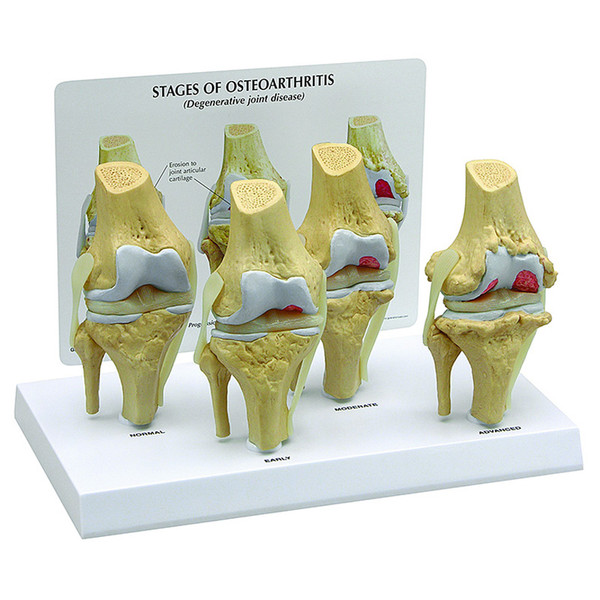 4-Stage Osteoarthritis Knee Model