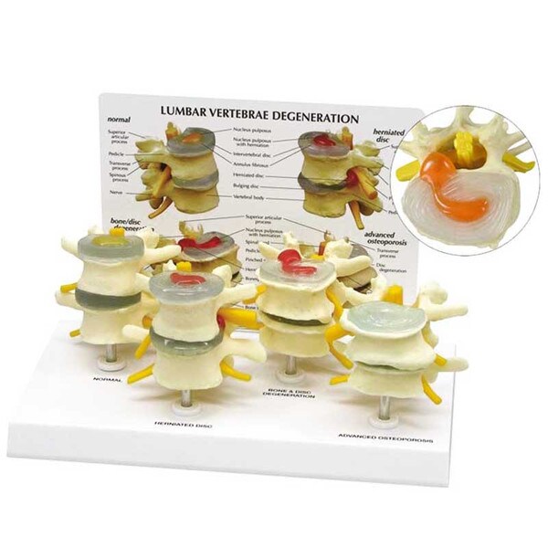 4-Stage Vertebrae Model