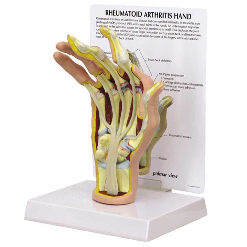 Rheumatoid Arthritis Hand Model SME, USA